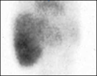 Gammagrafía de hemangiomas (óseos, gastrointestinales y hepáticos)
