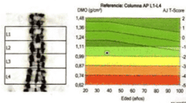 Densitometría ósea (columna lumbar, fémur, antebrazo)