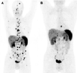 PET-TC con 68Ga-DOTATOC