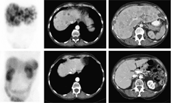Gammagrafía con receptores de somatostatina