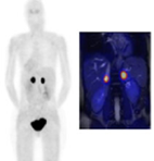 PET-TC con PSMA