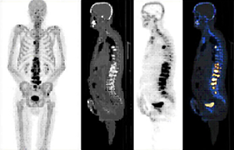 PET-TC con 18F-Fluoruro de sodio (18F-NaF)