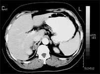 Gammagrafía suprarrenal cortical (con o sin frenación)