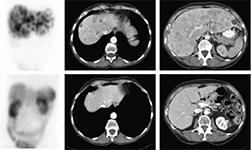Gammagrafía con receptores de somatostatina