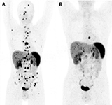 PET-TC con 68Ga-DOTATOC