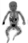 NeuroblastomaPediatricFDOPA